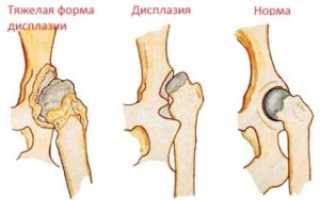 Как проявляется соединительнотканная дисплазия