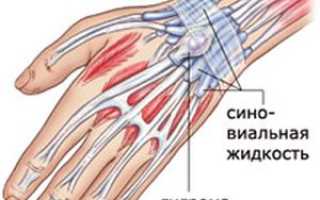 Симптомы и методы лечения гигромы лучезапястного сустава
