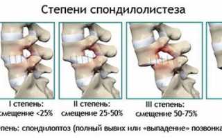Спондилолиз и спондилолистез поясничного отдела позвоночника