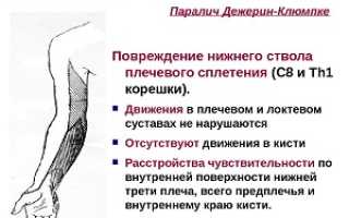 Особенности паралича Дежерина-Клюмпке