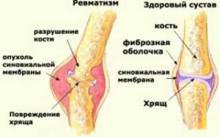 Ревматический полиартрит: сложности лечения и восстановления