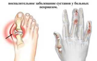 Симптомы, диагностика и лечение реактивного полиартрита
