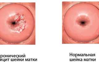 Эндоцервицит из за молочницы