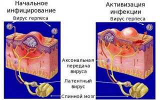 Комплексное лечение больных кандидозным баланитом и баланопоститом