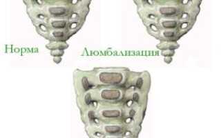 Люмбализация s1 — аномалия развития позвоночника
