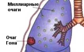 Пациент no 1 туберкулез легких
