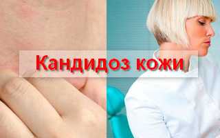 Лечение кандидоза кожи отзывы