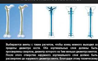 Что такое остеосинтез: описание процедуры, вопросы и ответы