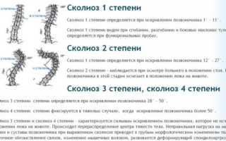 Что нужно знать об использовании массажа при сколиозе позвоночника