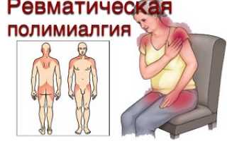 Проявления ревматической полимиалгии и способы ее лечения