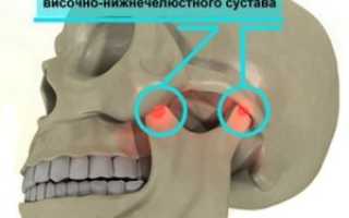 Причины, симптомы и лечение артрита височно-нижнечелюстного сустава