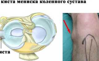 Все о менисках: строение, функции, болезни и травмы