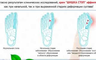 Крем Шишка Стоп — уникальный состав от косточек и шишек на ногах
