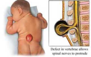 Чем вызвано расщепление позвоночника (Spina bifida)