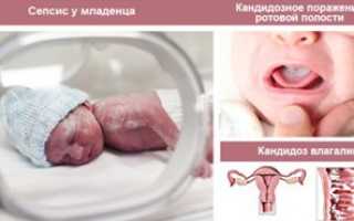 Молочница как протирать кандид