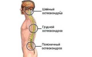Подход к лечению остеохондроза грудного отдела позвоночника