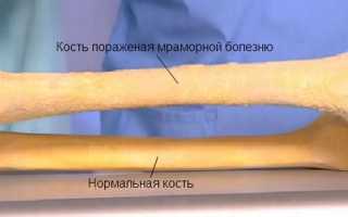 Остеопетроз -смертельный мрамор, который разбивает жизни