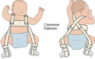 Профилактика и лечение дисплазии тазобедренных суставов у новорожденных