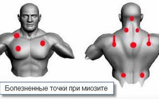 Симптомы и лечение миозита грудной клетки