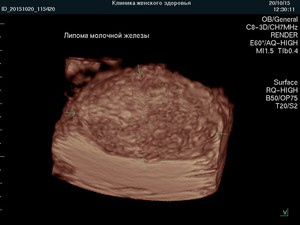 3D-фото липомы молочной железы 3D-фото липомы - как выглядит образование.