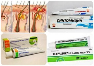 Антибактериальные мази от прыщей могут помочь Антибактериальные мази неплохо помогают избавляться от прыщей, если они не аллергические.