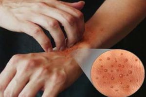 Атопический дерматит запястья у взрослых Атопический дерматит запястья сопровождается часто зудом.