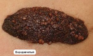 Бородавчатый невус Формы и размеры бородавчатого невуса