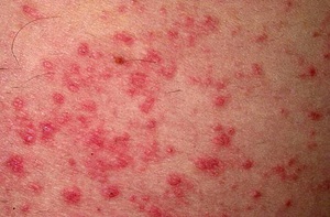 Candida albicans грибковая инфекция, которая вызывает кандидозный дерматит Candida albicans - это грибковая форма пеленочного дерматита.