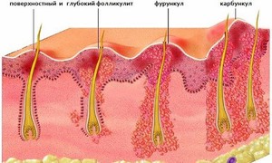 Фурункул на лобке Фурункул на лобке