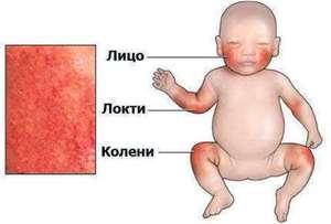 Расположение атопического дерматита у младенцев Где бывает дерматит у малышей - наглядная схема.