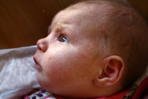 Аллергическая сыпь на лице Сыпь на теле новорожденного