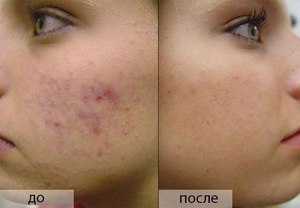 Профилактические меры Как следить за кожей лица
