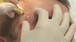 Лечение папиллом лазером Как лечат папилломы