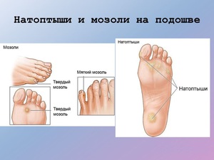Лечение натоптышей, лечение мозолей в домашних условиях Вылечить сухие мозоли можно в косметологическом салоне и дома