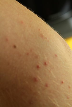 Лечение прыщей на теле Как вылечиться от прыщей