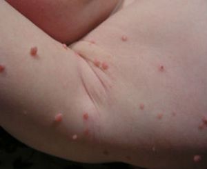 Лазерное удаление контагиозного моллюска у детей и взрослых Что такое контагиозный моллюск
