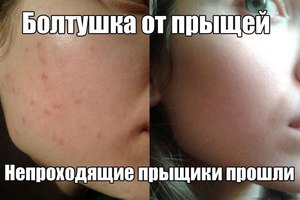 Последствия применения болтушки от прыщей Лечение прыщей при помощи болтушки очень эффективно.