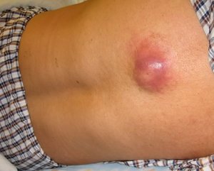 Восполившаяся липома (жировик) Липома (жировик) может воспалиться.
