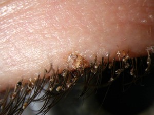Лобковые вши на ресницах Как бороться с лобковыми вшами