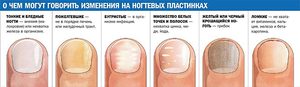Грибок ногтей - фото здоровых и больных ногтей. Грибковые инфекции на ранних стадиях лечатся достаточно просто.