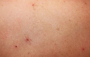 Почему прыщи еще и чещутся Причина появления прыщей
