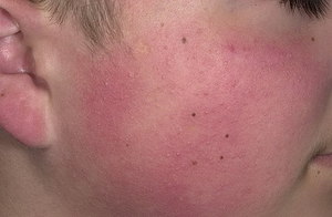Народные средства от гиперкератоза Лечение фолликулярного гиперкератоза