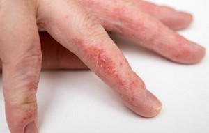 Симптомы заболевания кожи рук Как проявляется заболевание на пальцах