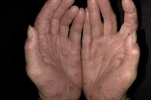 Псориаз на руках Как вылечиться от псориаза