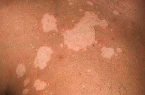 Народные методы лечения отрубевидного лишая Народная медицина при отрубевидном лишае