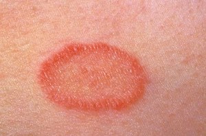 Розовый лишай: материнская бляшка Розовый лишай - особенности заболевания