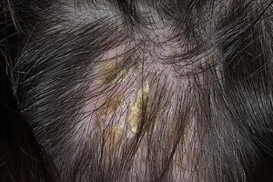 Себорея волосистой части головы Себорея кожи головы