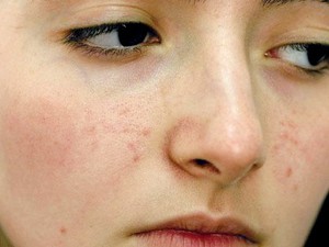Как убрать пятна после прыщей Как избавиться от пятен от прыщей на лице