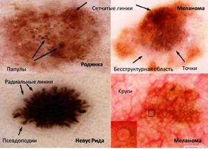 Обзор стадий развития меланомы Стадии развития меланомы показаны на фото.