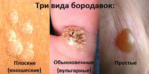 Бородавки бывают разных типов. Есть разные причины возникновения бородавок.